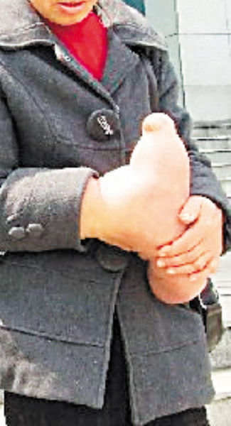 彭求芝的“巨手”给她日常生活带来很大困难，她每天只能抱着这个手。 李小雷 摄