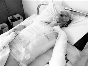 周小姐的头、颈、躯干、四肢均被烧伤，其中面部烧伤最为严重。