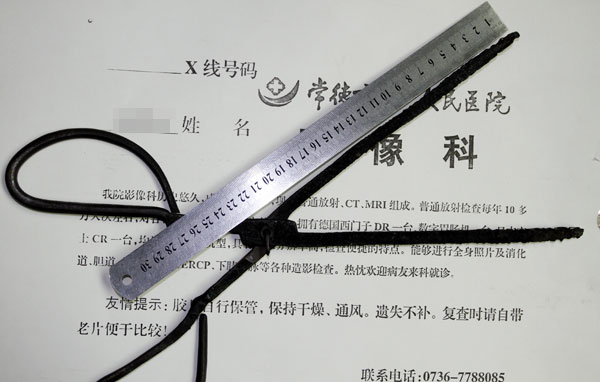 太惊悚!常德男遭20厘米火钳穿越咽颊与口腔\/图 - 三湘万象 - 湖南在线 - 华声在线