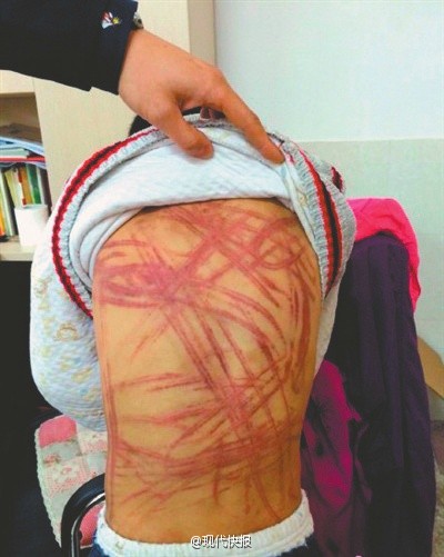 南京虐童案中受害儿童后背受伤