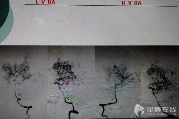 （DSA造影下，异常增生的血管如烟雾一般。 刘雨滋/供图）