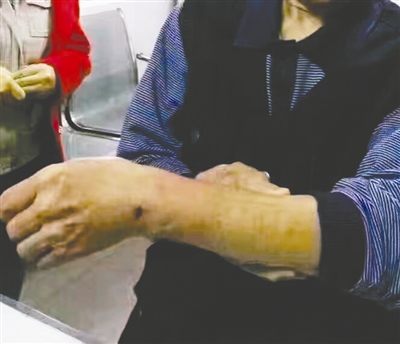 一位市民的手背被咬伤