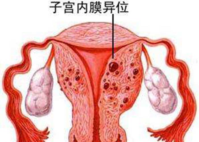 宫腹腔镜联合手术的优势及子宫内膜异位囊肿的治疗