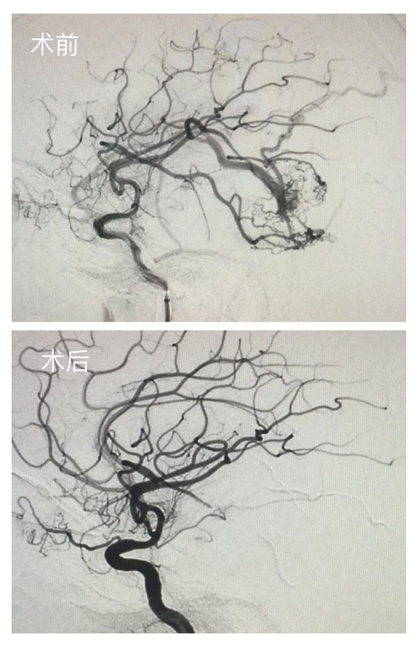 ——州人民医院在州内首次成功开展颅内动静脉畸形血管内介入手术