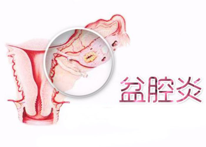 认识盆腔炎 远离盆腔炎
