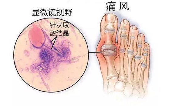 世界杯期间痛风及尿酸增高患者直线上升,医生