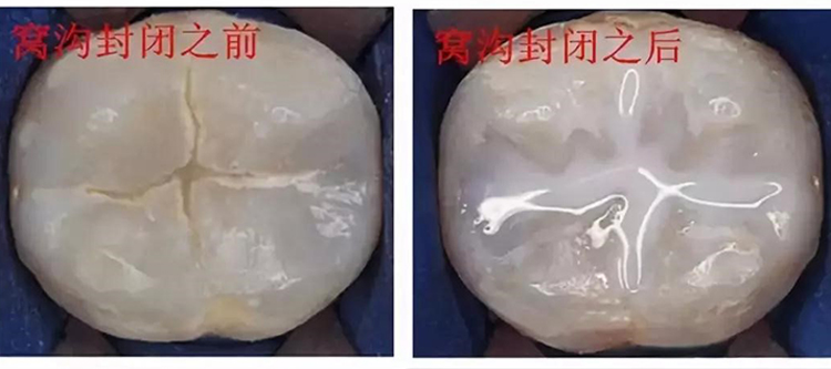 无需挂号 湘雅口腔医院为6-12岁儿童免费看牙