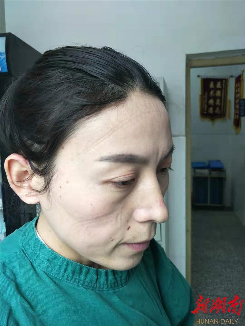 连续工作 小时的感染科医务人员刚摘下防护口罩,帽子