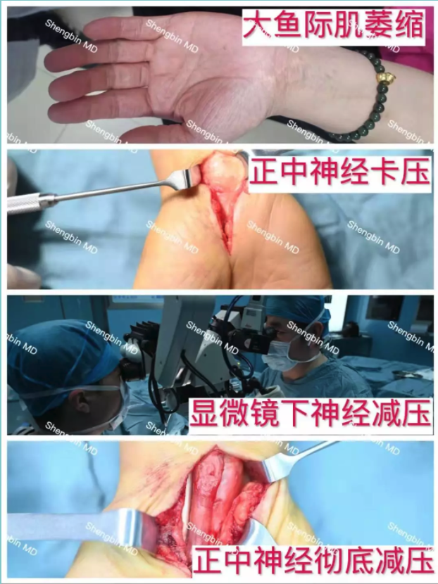 盛主任在显微镜下行神经减压术