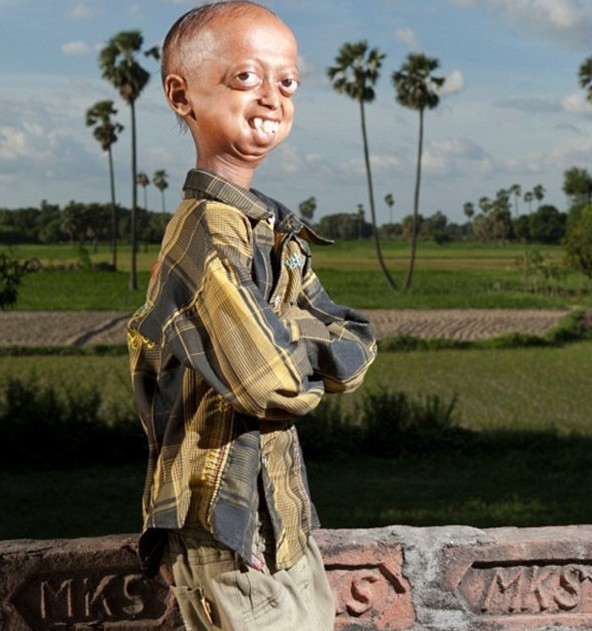 印度14岁男童患早衰症躯体已百岁