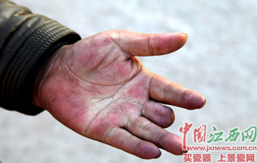 唯一剩下的手掌也开始发黑 徐江山担心病情又会复发