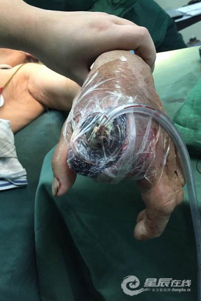 长沙七旬老太迷信法术致手指溃烂截指图