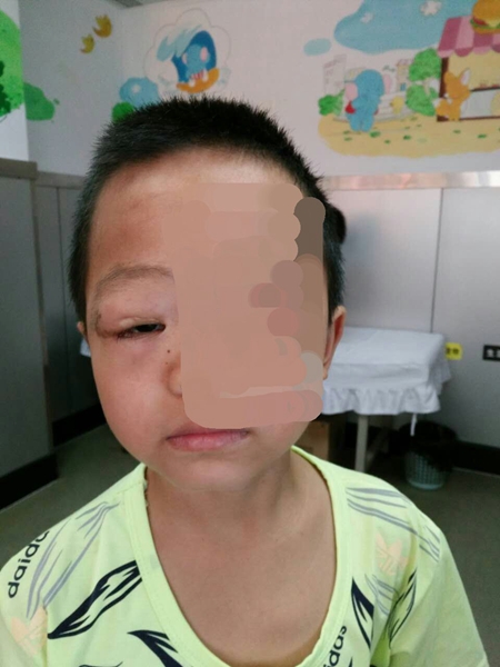 女童因弟弟出生后被忽略导致视力下降 news.voc.com.cn