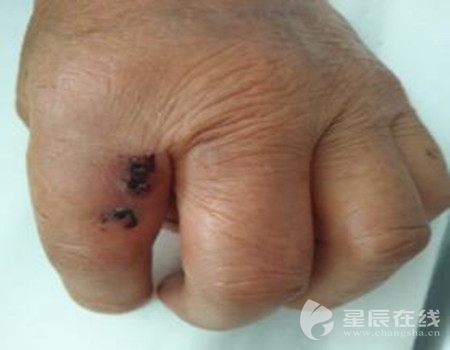 老鼠被药倒后"装死" 咬伤人致凝血功能障碍