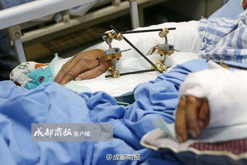 饲养员被熊猫咬成重伤 双手腕骨被咬断