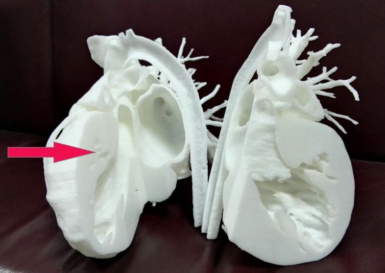 3D打印心脏，手术不再“凭空想象”