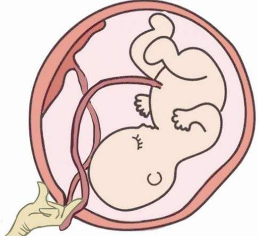 脐带脱垂到底有多危险 产科医生又为何要全程跪地托举