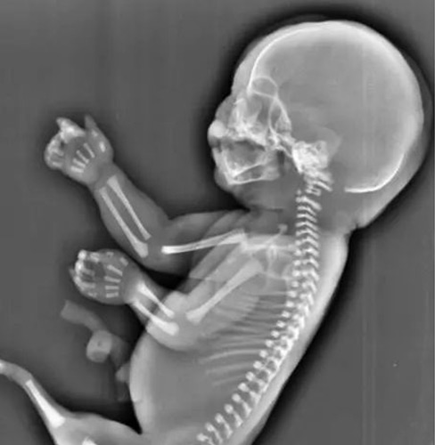 怀孕x光照片怀孕早期图片
