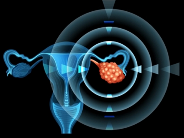 人造卵巢 或助癌症患者怀孕！