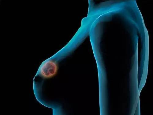 妊娠34周以上 可降低乳腺癌风险