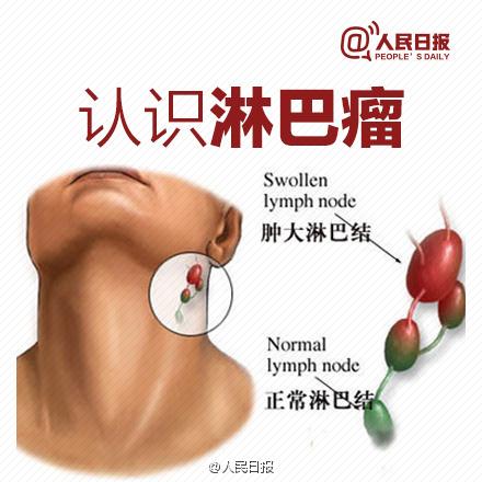 脖子粗确诊淋巴瘤，男子动手术