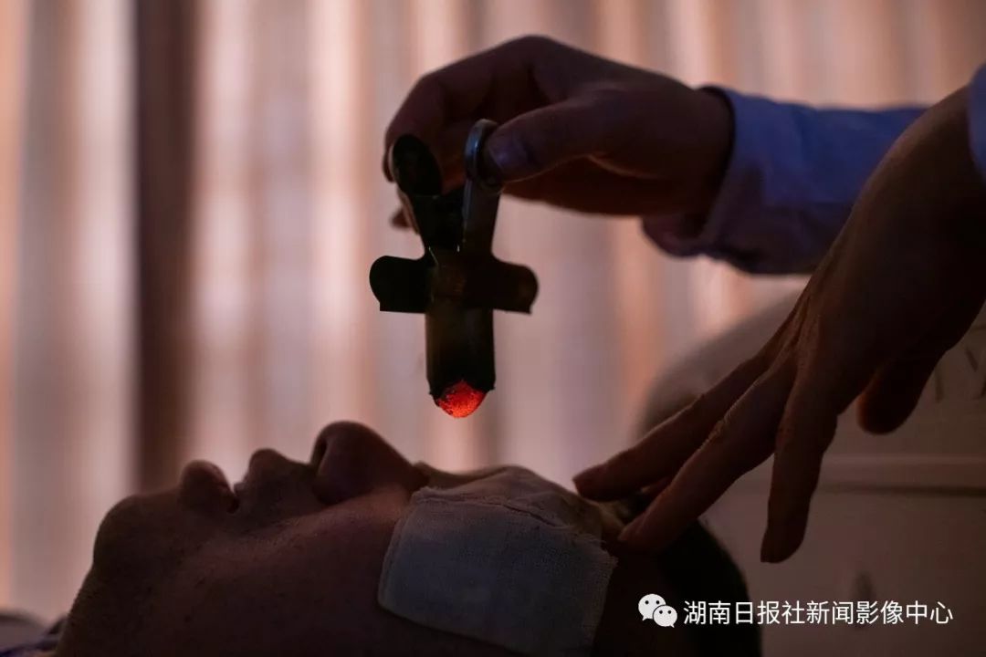 中医艾灸治疗眼睛.